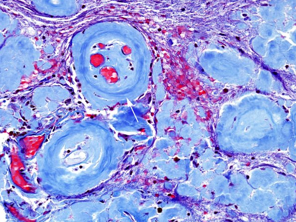 1G2 Amyloidoma, cerebral (Case 1) Trichrome 3 copy