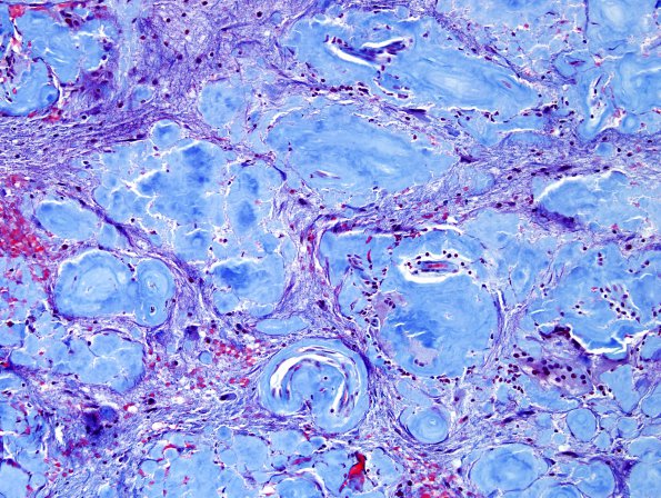 1G3 Amyloidoma, cerebral (Case 1) Trichrome 1