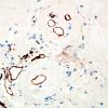 1H2 Amyloidoma, cerebral (Case 1) CD34 3