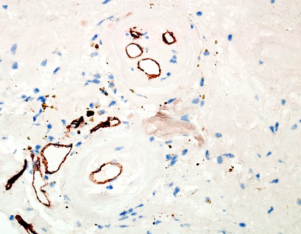 1H2 Amyloidoma, cerebral (Case 1) CD34 3