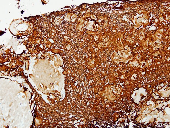 1I Amyloidoma, cerebral (Case 1) GFAP 2