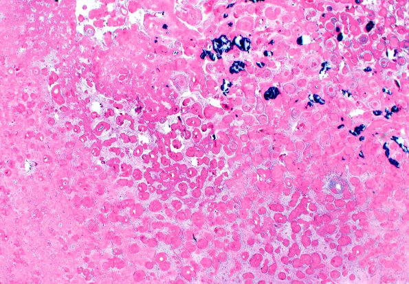 2A2 Amyloidoma (Case 2) H&E 10