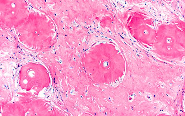 2A4 Amyloidoma (Case 2) H&E 8