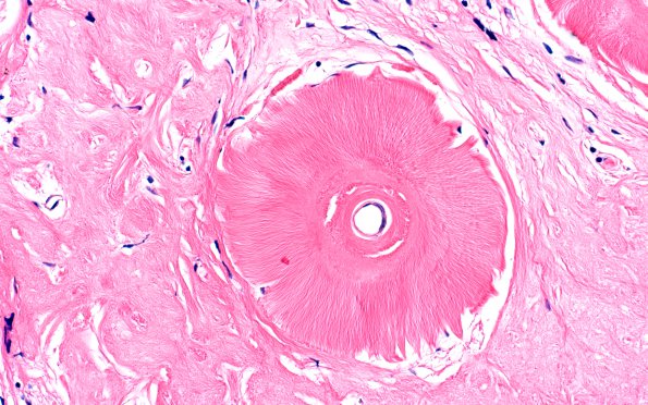 2A5 Amyloidoma (Case 2) H&E 7