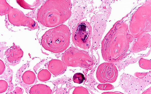 2A6 Amyloidoma (Case 2) H&E 5