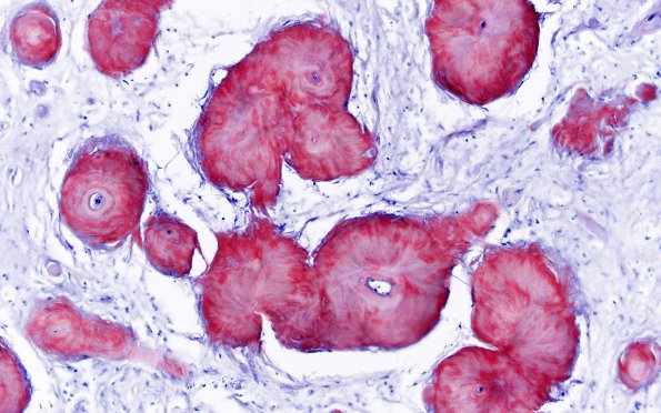 2B2 Amyloidoma (Case 2) CR nonpol 5