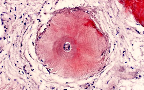 2B5 Amyloidoma (Case 2) CR nonpol 1