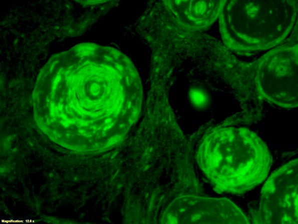 2C3 Amyloidoma (Case 2) Thio-S 5