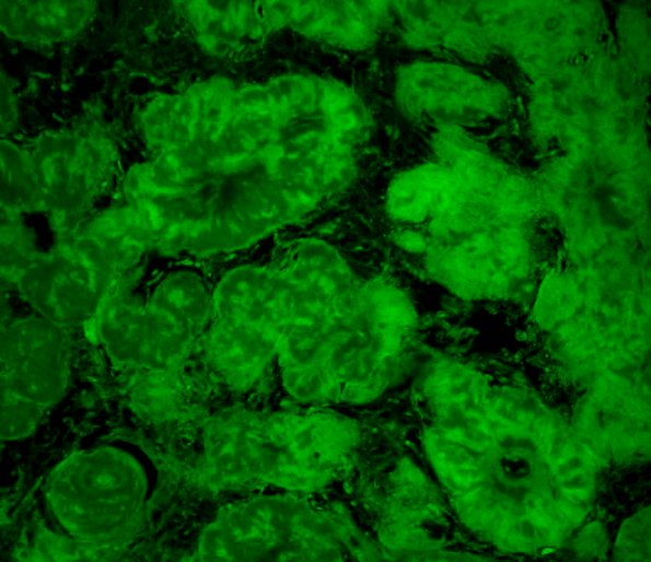 2C5 Amyloidoma (Case 2) (Thio-S) 12