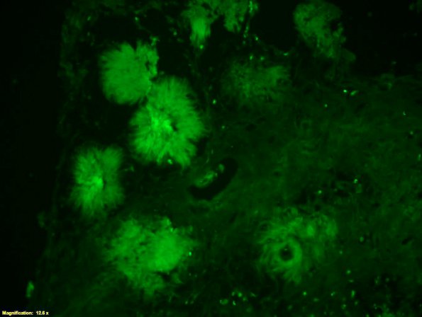 2C6 Amyloidoma (Case 2) Thio-S 14