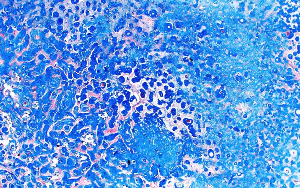 2D1 Amyloidoma (Case 2) Trichrome 3