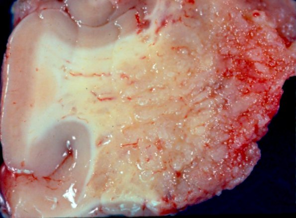 3A Amyloidoma (AANP 1991, Case 2) Gross