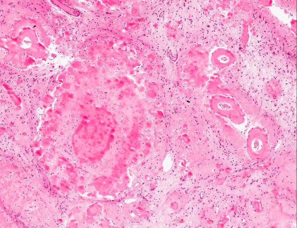 3B4 Amyloidoma (AANP 1991, Case 2) H&E X7