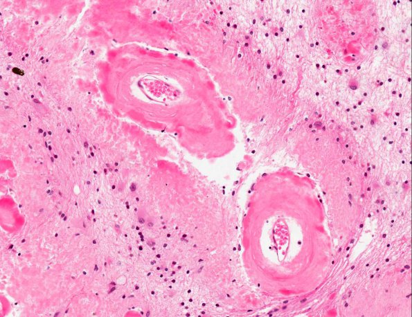 3B5 Amyloidoma (AANP 1991, Case 2) H&E X20 1