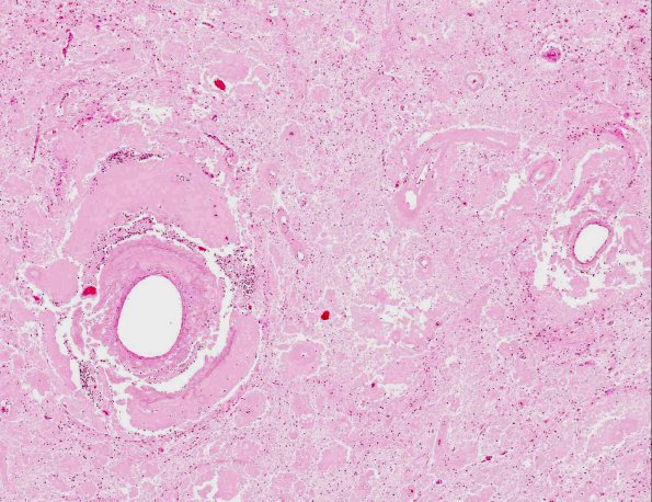 6A2 Amyloidoma (AANP 1991, Case 1) H&E X4 1