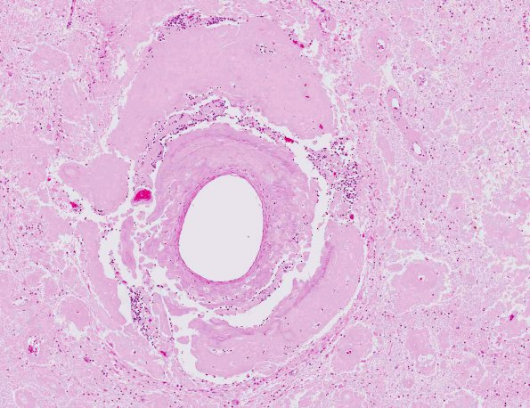 6A3 Amyloidoma (AANP 1991, Case 1) H&E X6