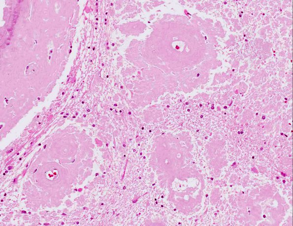 6A5 Amyloidoma (AANP 1991, Case 1) H&E X20 1