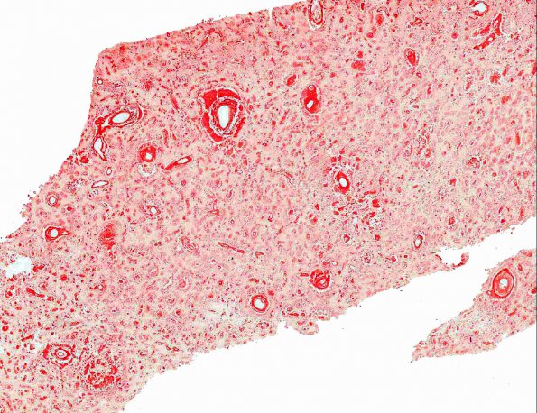 6B1 Amyloidoma (AANP 1991, Case 1) Congo Red X1