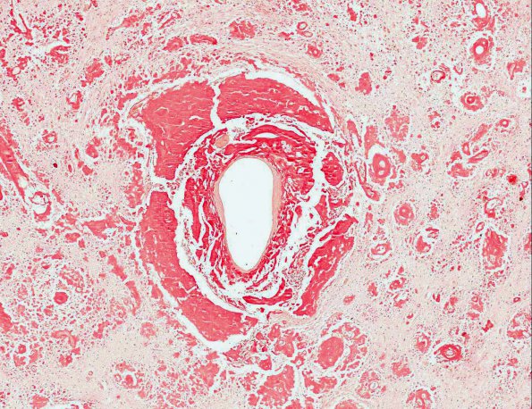 6B3 Amyloidoma (AANP 1991, Case 1) Congo Red X5 1