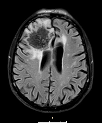 7A1 Amyloidoma (Case 7) T2 FLAIR - Copy