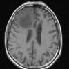 7A2 Amyloidoma (Case 7) T1 noC - Copy