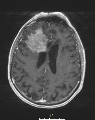 7A3 Amyloidoma (Case 7) T1W 2 - Copy
