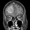 7A4 Amyloidoma (Case 7) T1W 2 COR - Copy