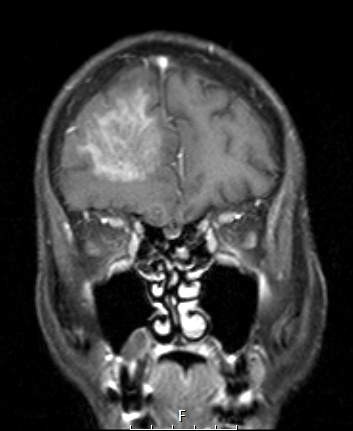 7A4 Amyloidoma (Case 7) T1W 2 COR - Copy
