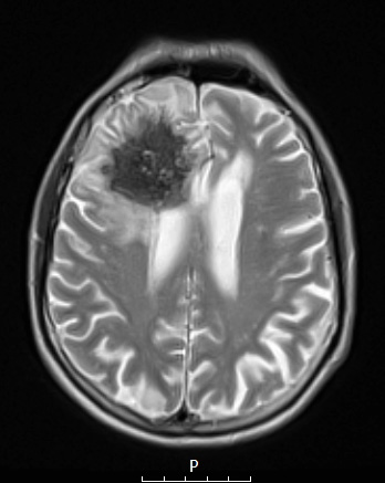 7A5 Amyloidoma (Case 7) T2 noC - Copy