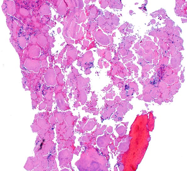 7B1 Amyloidoma (Case 7) H&E 4X