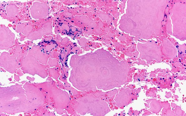 7B2 Amyloidoma (Case 7) H&E 10X