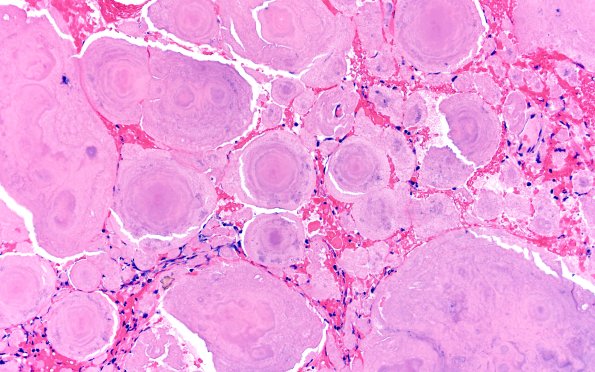 7B3 Amyloidoma (Case 7) H&E 20X 4
