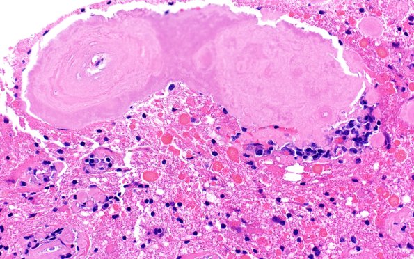 7B8 Amyloidoma (Case 7) H&E 40X 4