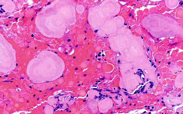 7B9 Amyloidoma (Case 7) H&E 40X 2