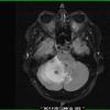 1A1 Calcifying Pseudoneoplasm Neuraxis (CAPNON) (Case 1) T2 FLAIR 1 - Copy