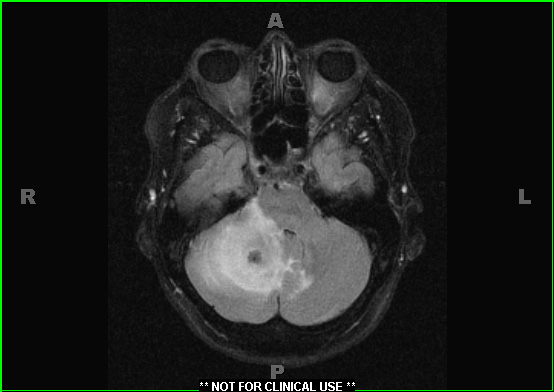 1A1 Calcifying Pseudoneoplasm Neuraxis (CAPNON) (Case 1) T2 FLAIR 1 - Copy