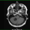 1A2 Calcifying Pseudoneoplasm Neuraxis  (Case 1) T1 2 - Copy