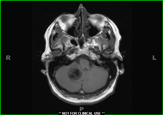 1A2 Calcifying Pseudoneoplasm Neuraxis  (Case 1) T1 2 - Copy