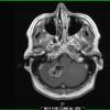 1A3 Calcifying Pseudoneoplasm Neuraxis (Case 1) T1 W 1 - Copy