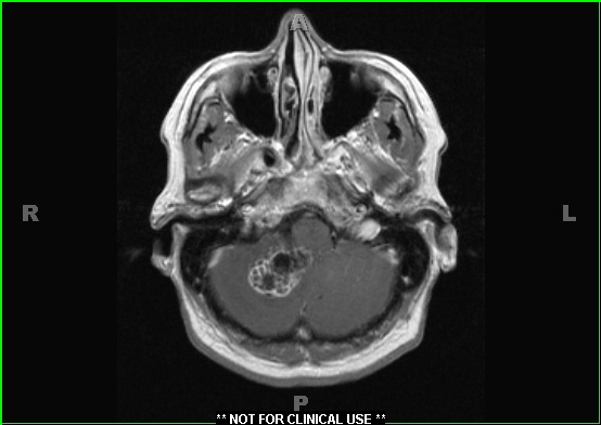 1A3 Calcifying Pseudoneoplasm Neuraxis (Case 1) T1 W 1 - Copy