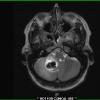 1A4 Calcifying Pseudoneoplasm Neuraxis (Case 1) T2 W 1 - Copy