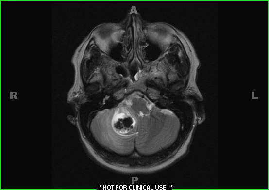 1A4 Calcifying Pseudoneoplasm Neuraxis (Case 1) T2 W 1 - Copy