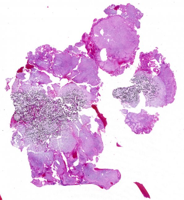 1B1 Calcifying Pseudoneoplasm Neuraxis (Case 1) H&E WM 1