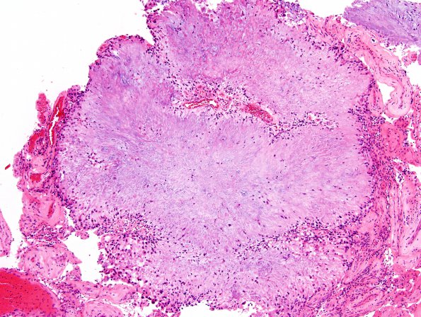 1B2 Calcifying Pseudoneoplasm Neuraxis (Case 1) H&E 11.jpg