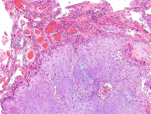 1B3 Calcifying Pseudoneoplasm Neuraxis (Case 1) H&E 1A