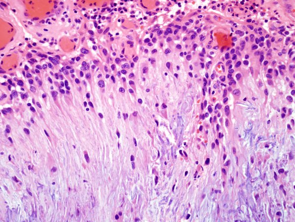 1B4 Calcifying Pseudoneoplasm Neuraxis (Case 1) H&E 5