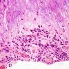 1B5 Calcifying Pseudoneoplasm Neuraxis (Case 1) H&E 2