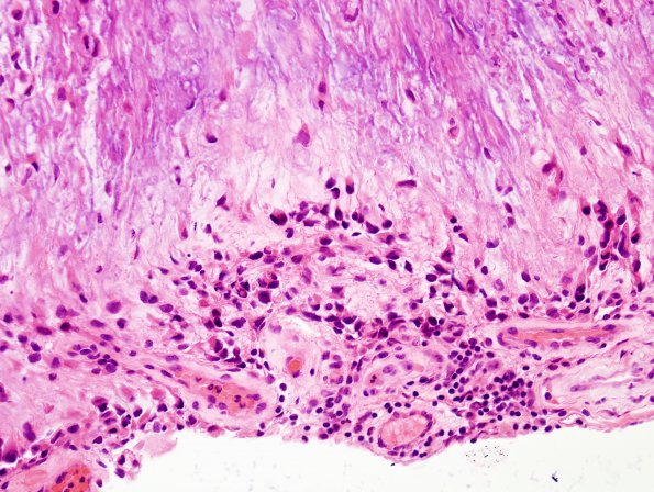 1B5 Calcifying Pseudoneoplasm Neuraxis (Case 1) H&E 2