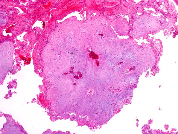 1B6 Calcifying Pseudoneoplasm Neuraxis (Case 1) H&E 14.jpg