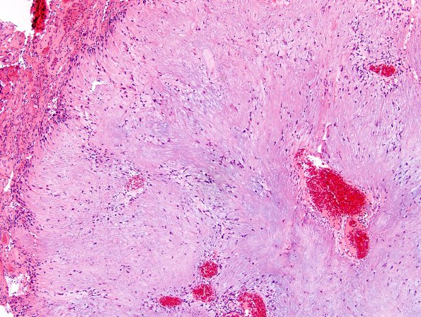 1B7 Calcifying Pseudoneoplasm Neuraxis(Case 1) H&E 15.jpg